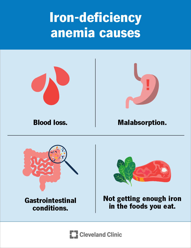 iron deficiency anemia