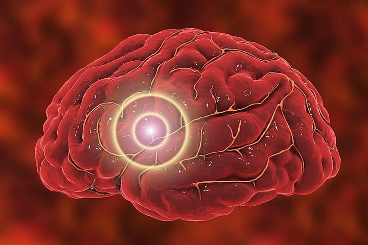 Stroke Rates Nearly Double In Younger Adults