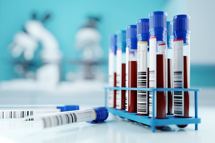 Social Media Posts Mislead About Blood Tests For Alzheimer’s