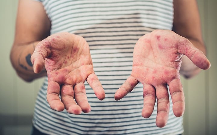Fifth Measles Death Reported As US Cases Reach New 35-Year High
