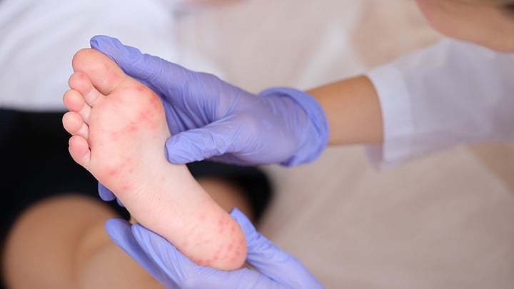 US Measles Outbreak Grows As New York Declares Emergency