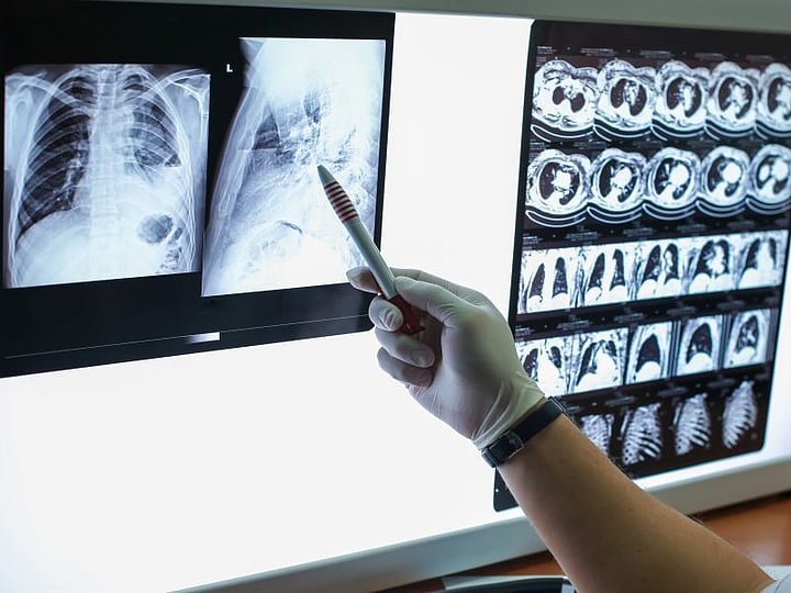 Patient Dies By Suicide After 'Insurance Issue' Delayed Medicine For Lung Disease Flare-Ups